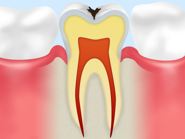 エナメル質虫歯
