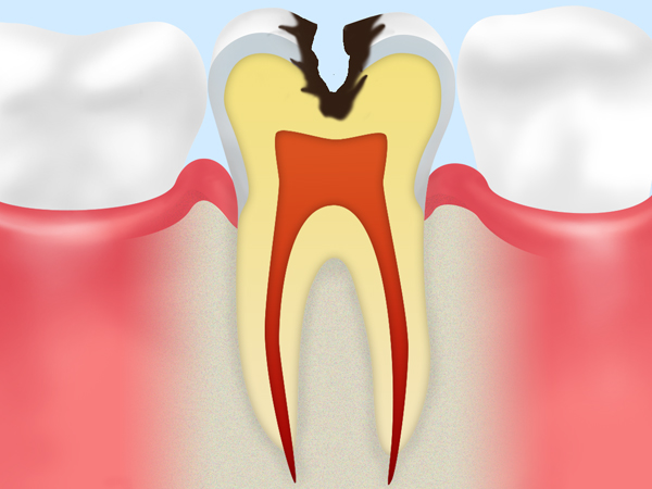象牙質虫歯